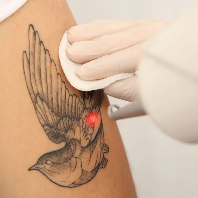 Tatuaje en brazo de un ave con un rayo láser removiéndolo en Kimberly Cala Estética Profesional